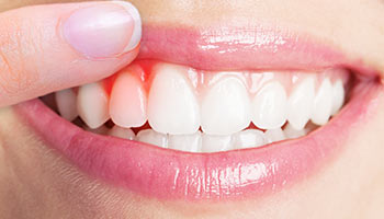 27岁女子长期横向刷牙致牙齿缺损：长期横向刷牙导致的楔形缺损